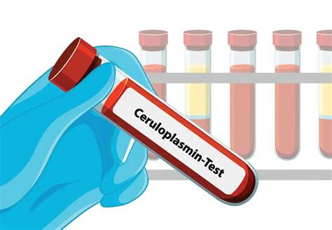 Ceruloplasmin An Overview Sciencedirect Topics Ceruloplasmin An Overview Sciencedirect Topics