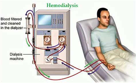 Does Dialysis Destroy Your Heat: Myths, Risks, And Coping Tips For Patients