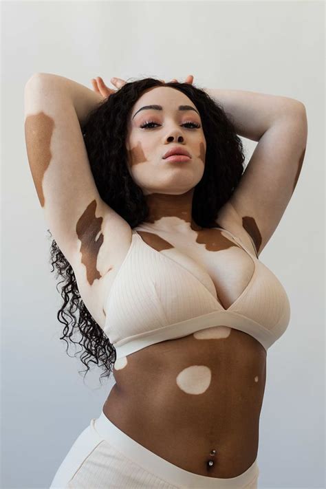Celebrating Beauty: Nude Vitiligo Photography.